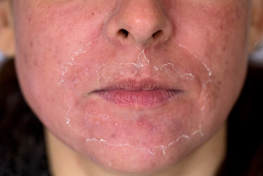 Il peeling della pelle del viso fa paura? Sapere prima quali sono le cause