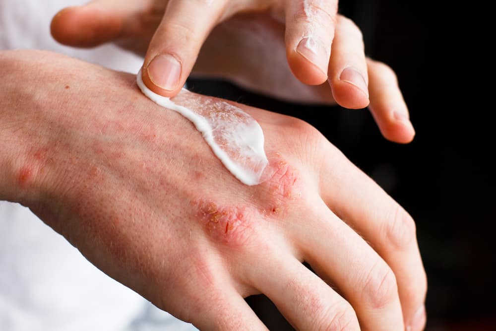 Medicine naturali e modi che aiutano ad alleviare le reazioni allergiche sulla pelle