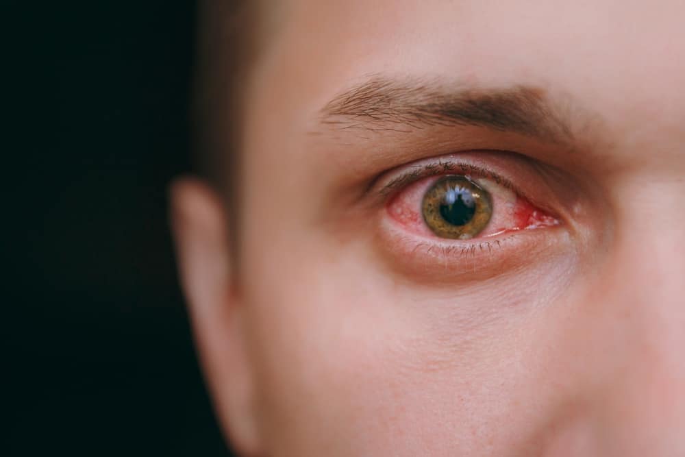 コンタクトレンズを着用したときの赤目の6つの一般的な原因