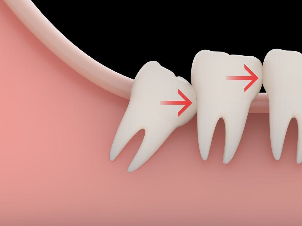 ค้นหาว่าฟันคุดของคุณมีปัญหาหรือไม่