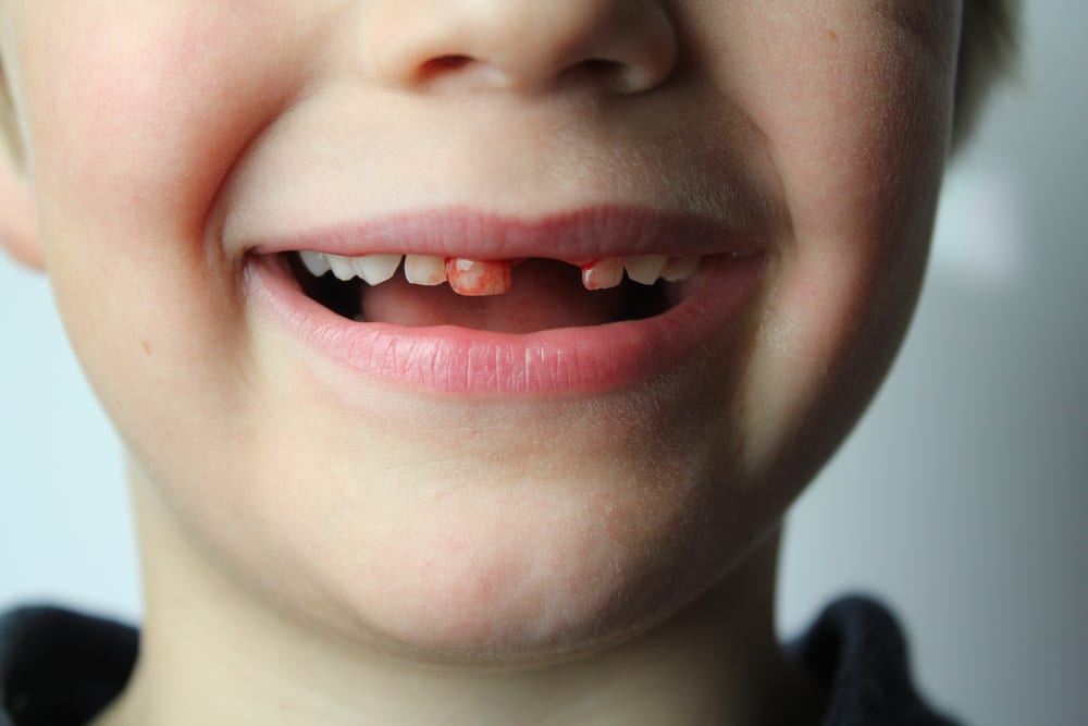 4 نصائح قوية لوقف نزيف اللثة بعد خلع الأسنان