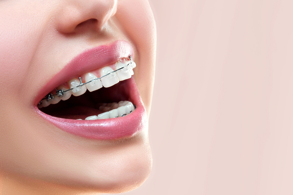 Prima di scegliere, controlla le 4 differenze tra Bretelle e Invisalign per raddrizzare i denti