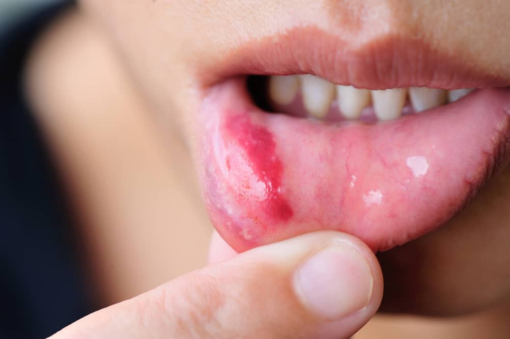 4 أنواع من تقرحات الفم وأسبابها يجب الانتباه إليها