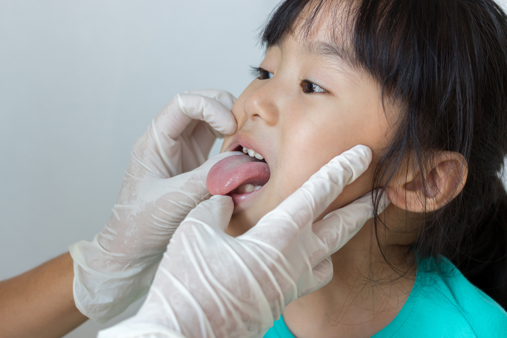 5 cause di lingua sanguinante dal mughetto al cancro