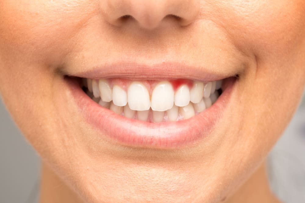 3 أنواع من الفيتامينات الفعالة للتغلب على التهابات اللثة والأسنان