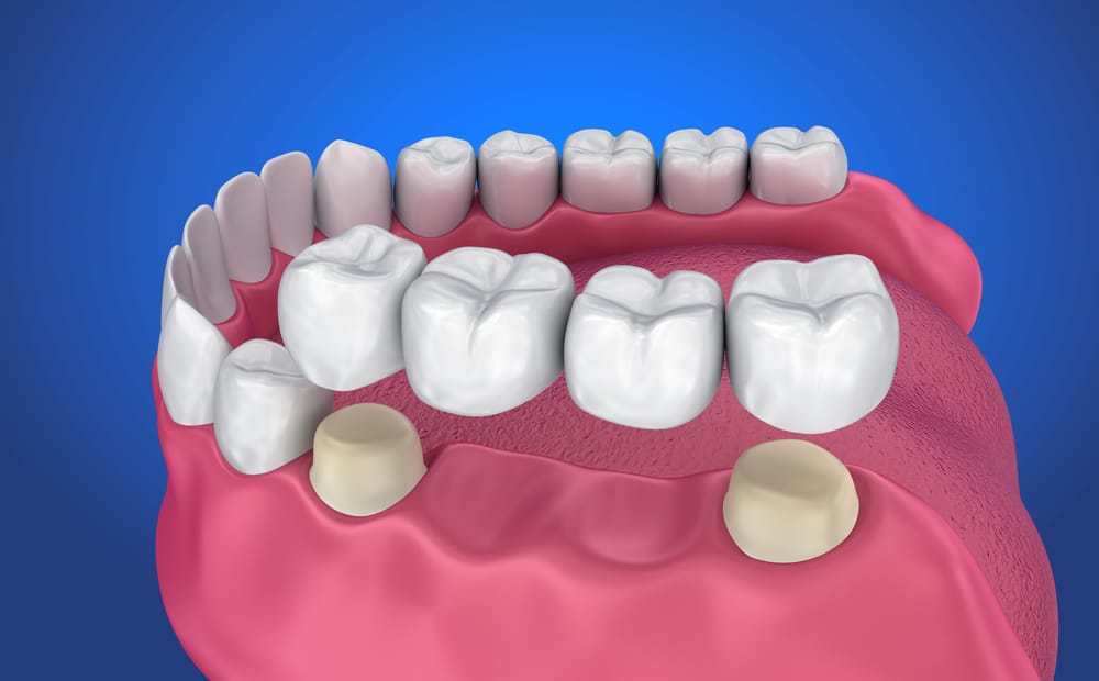Conoscere la procedura del ponte dentale per correggere i denti allentati