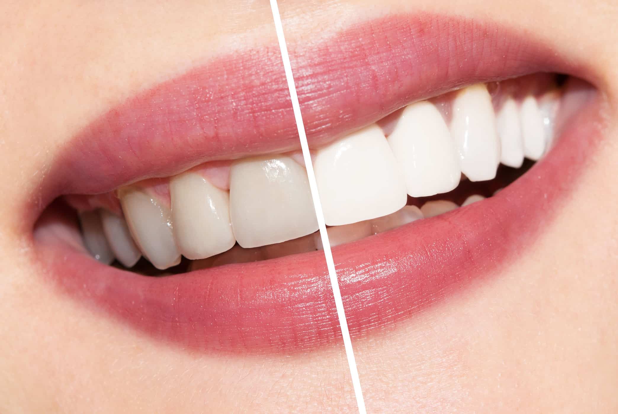 طرق مختلفة لتبييض الأسنان عن طريق علاج الطبيب