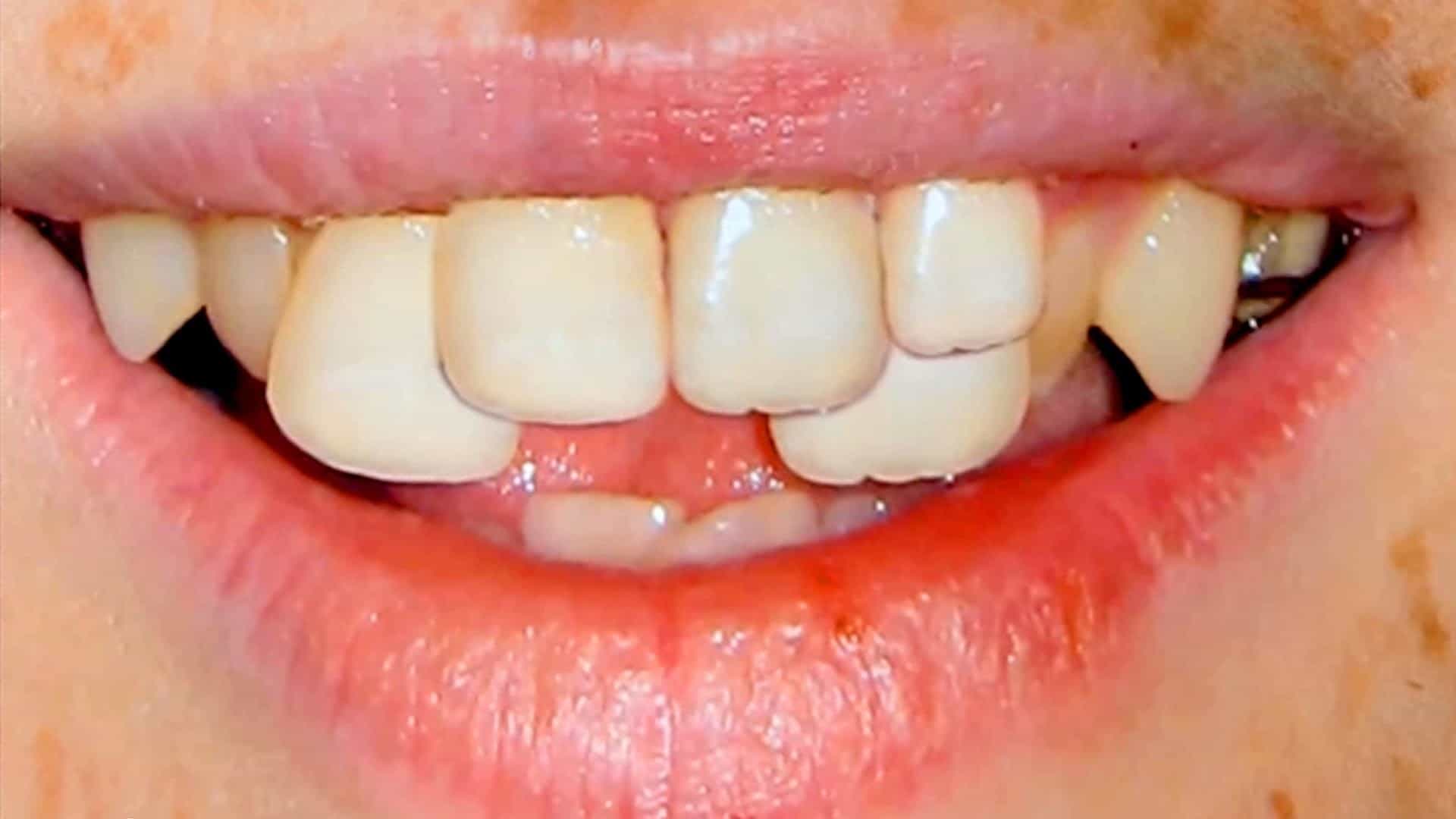 6 condizioni che causano lo spostamento dei denti e come superarlo