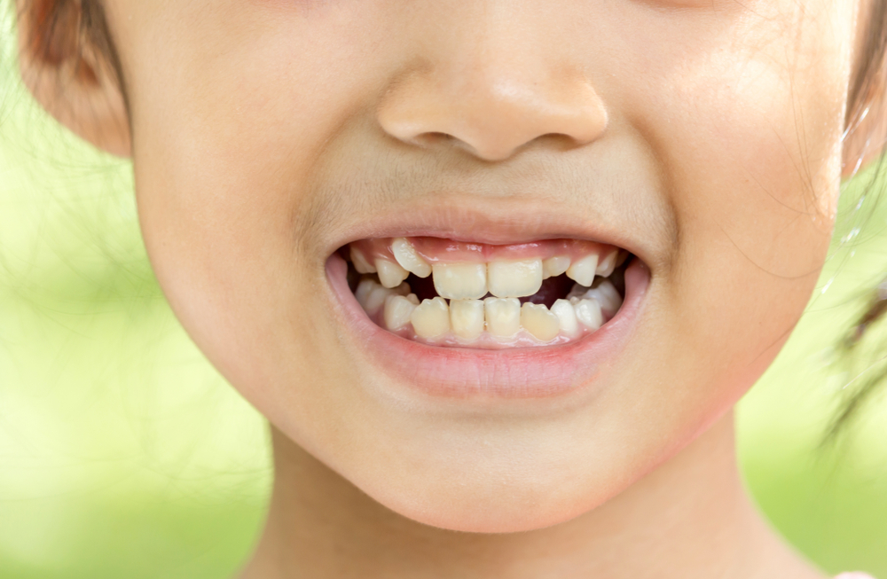 أسباب مختلفة لنمو أسنان الأطفال بشكل غير منتظم