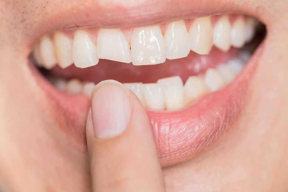 I denti rimangono fragili anche se sei stato diligente nel lavarti i denti, come mai?