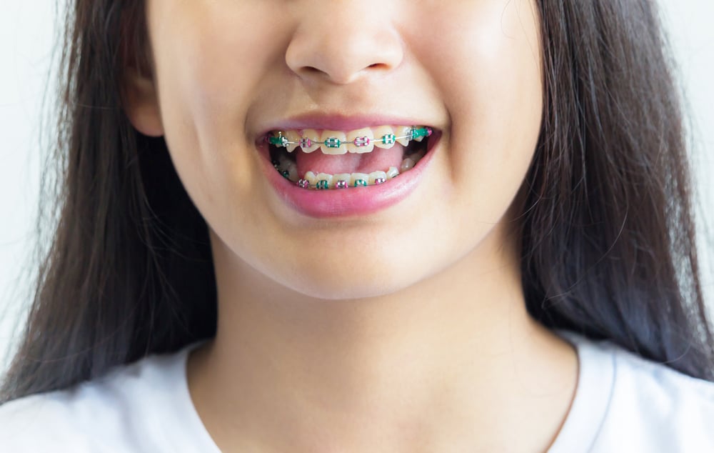 يمكن أن تجعل الأقواس الأسنان صفراء ، صحيحة أم خاطئة؟