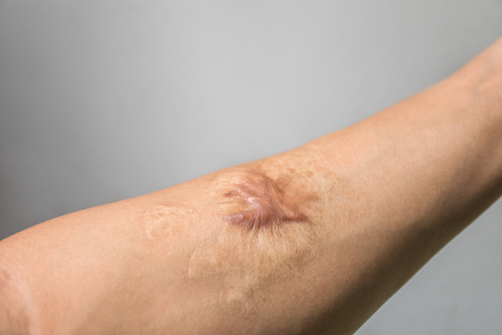 Cicatrici prominenti sulla pelle, potrebbero essere cheloidi o cicatrici ipertrofiche