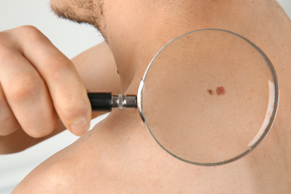 تمييز 5 أنواع من سرطان الجلد حسب خصائصها