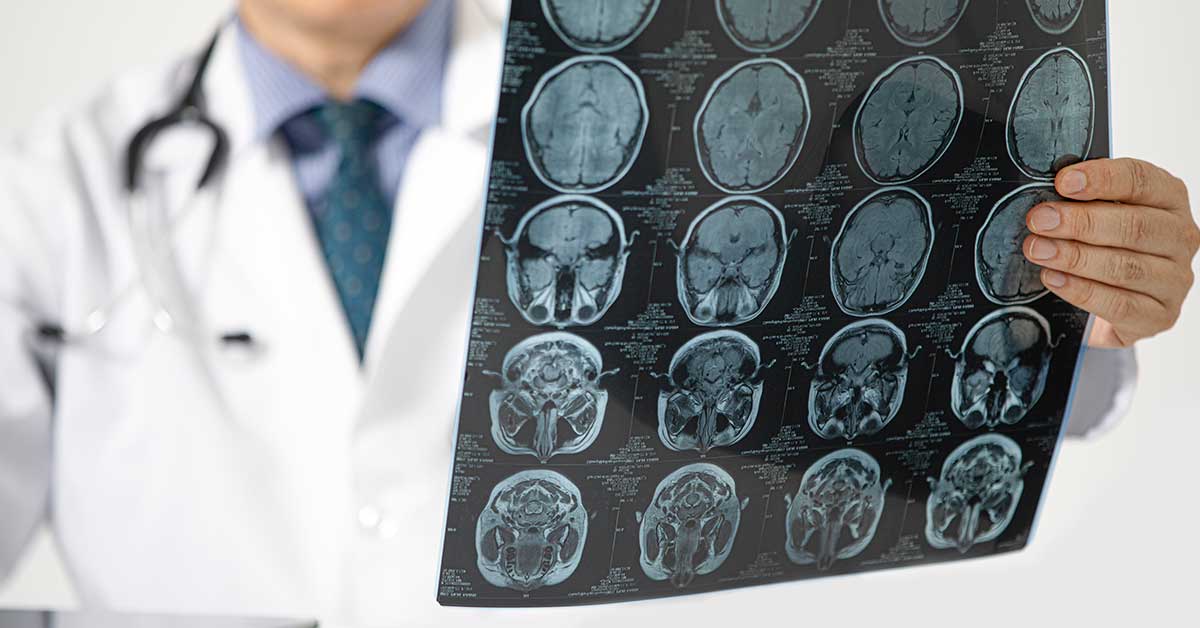 Diversi tipi di chirurgia per il cancro al cervello e i loro effetti collaterali