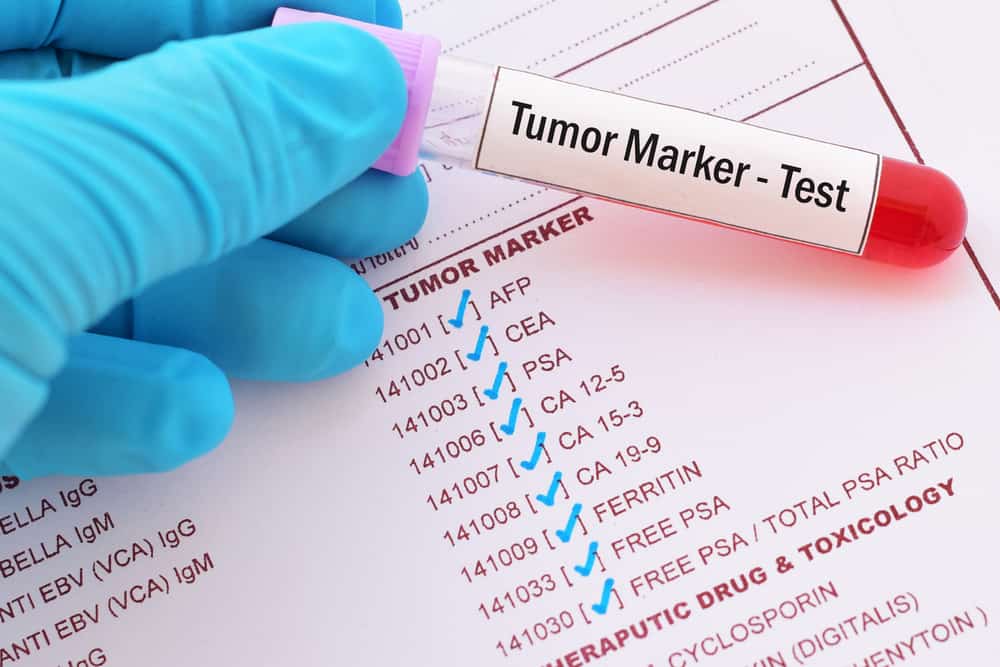 Conoscere i vantaggi e i tipi di marcatori tumorali per lo screening del cancro