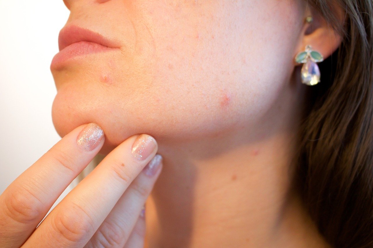 Motivi per cui l'acne compare anche dopo il trattamento