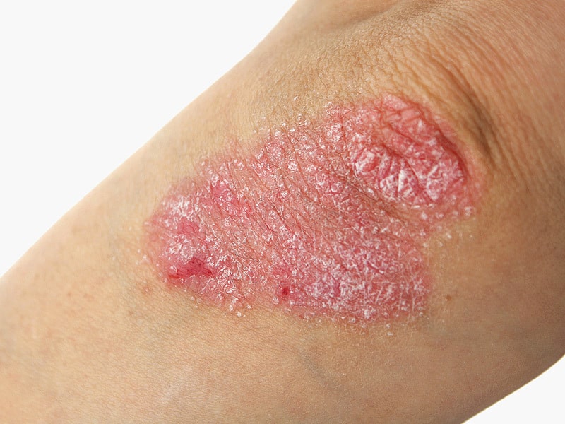 一般的およびタイプ別の乾癬のさまざまな症状