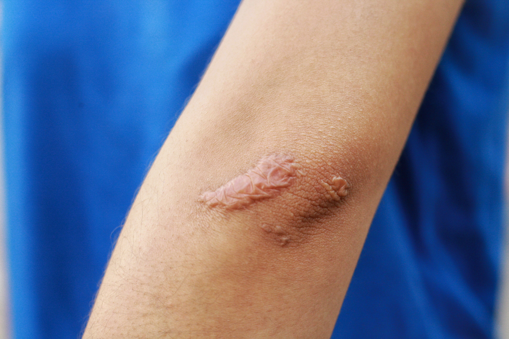 Come sbarazzarsi delle cicatrici annerite dall'eczema?