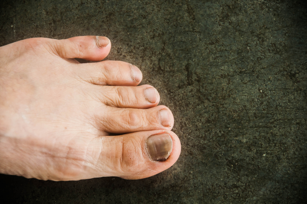 3 cause delle unghie dei piedi così annerite e ispessite