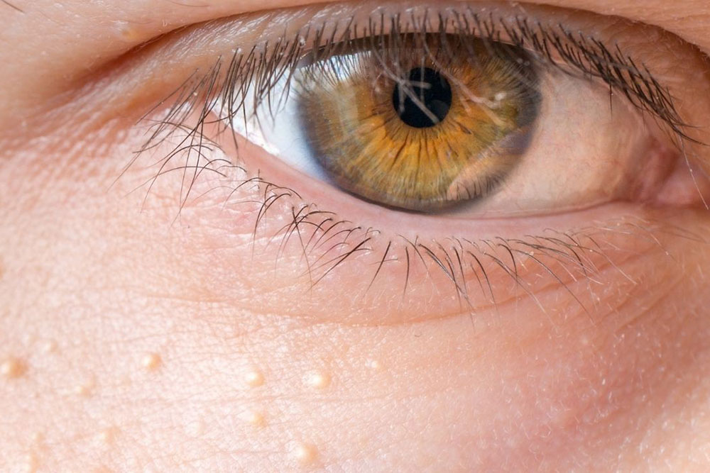 Riconosci il siringoma, piccoli grumi che compaiono spesso intorno agli occhi