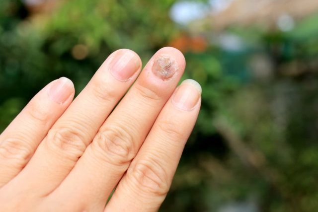 Varie cause di funghi sulle unghie che devi sapere