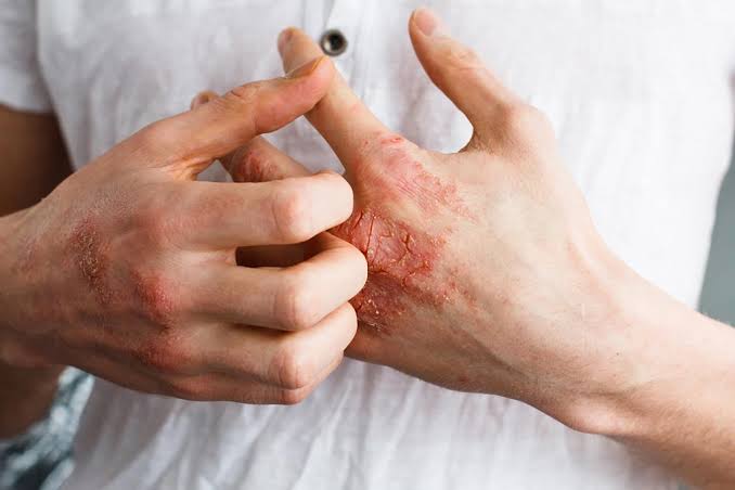 أنواع مختلفة من التهاب الجلد حسب الأسباب والأعراض