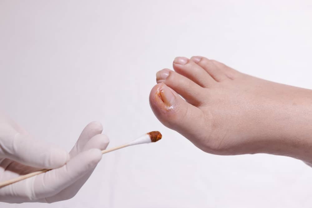 I 3 tipi più comuni di problemi alle unghie dei piedi (oltre a come superarli)