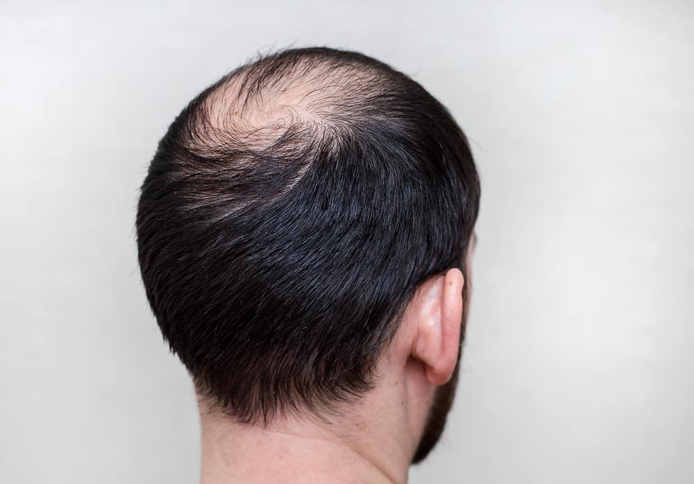 7 طرق طبيعية للتغلب على تساقط الشعر بسبب الصلع