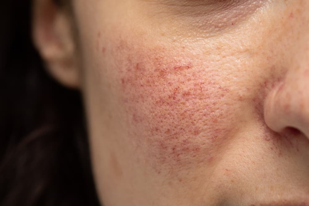 Ugualmente rosso sulla pelle, qual è la differenza tra rosacea e acne?