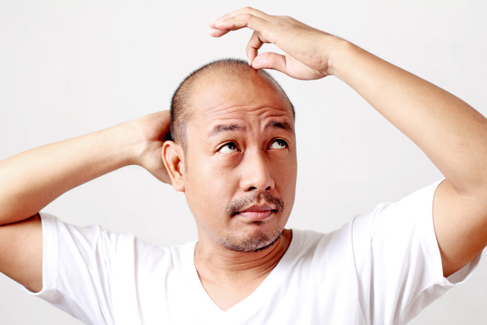 禿げた髪の治療、何に注意を払うべきですか？
