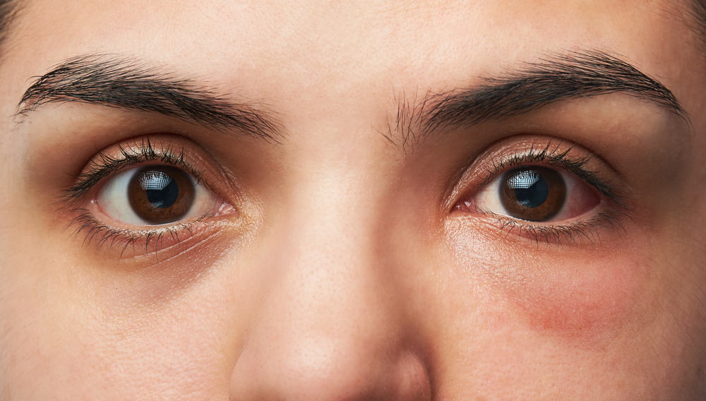 5 أسباب لعدوى العين التي تحدث غالبًا (قد تكون أمراضًا جنسية ، كما تعلم!)