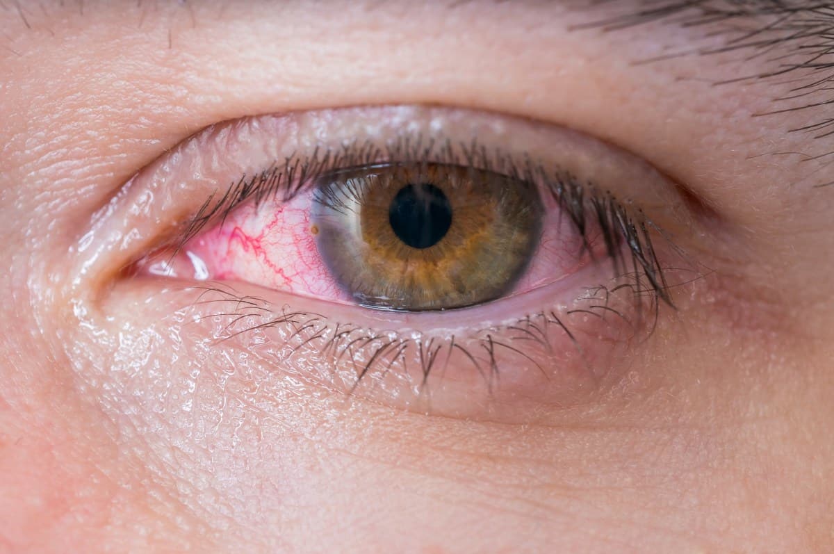 Attenzione alle caratteristiche degli occhi rossi a causa del sanguinamento nel bulbo oculare