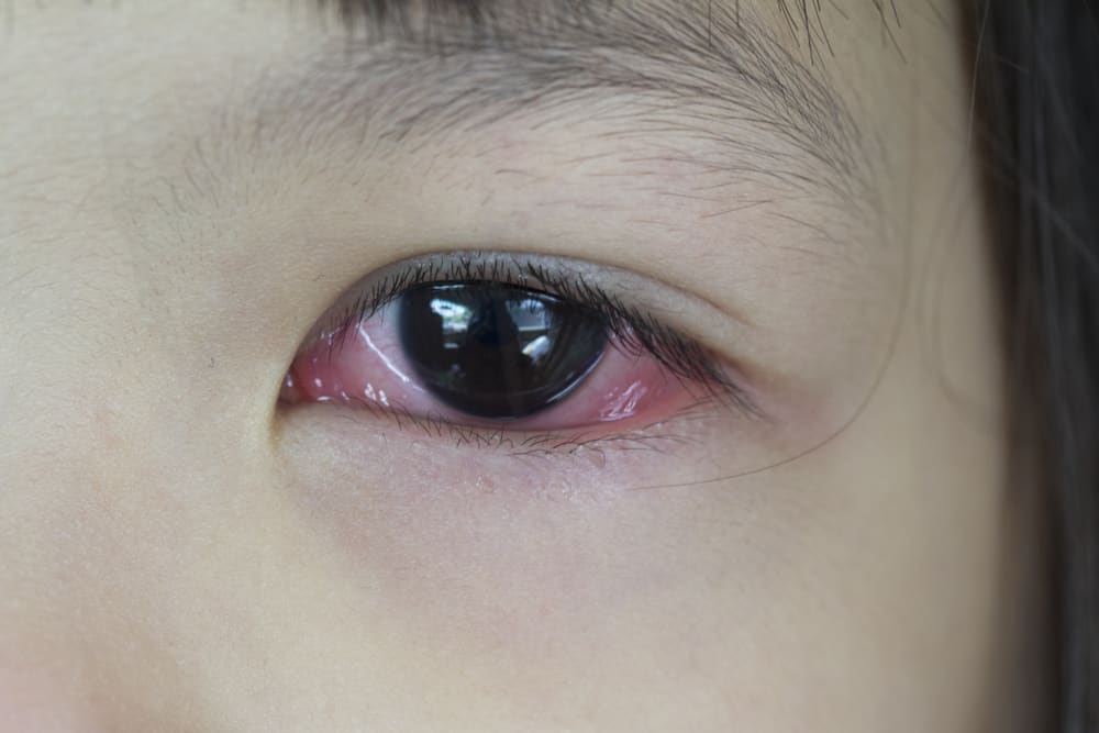أسباب احمرار العيون بعد البكاء