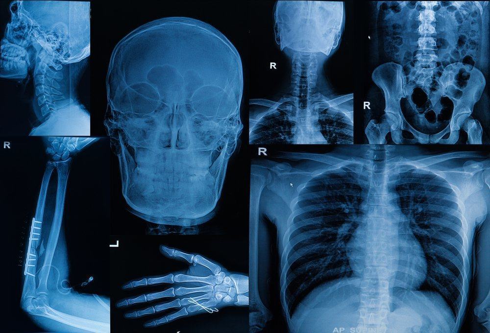 Cosa devi sapere prima di sottoporti a una scintigrafia ossea