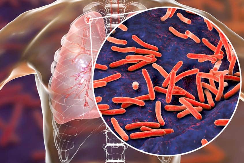 Attenzione alla tubercolosi latente, è necessario un trattamento?