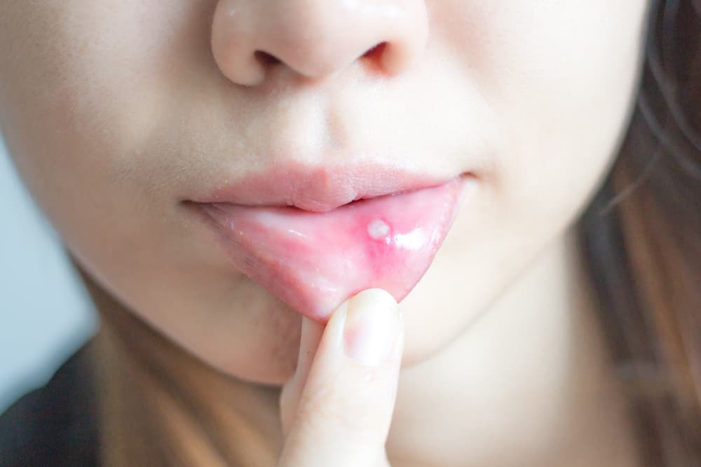 لا تستهدف عدوى فيروس الورم الحليمي البشري الأعضاء التناسلية فحسب ، بل تستهدف الفم أيضًا