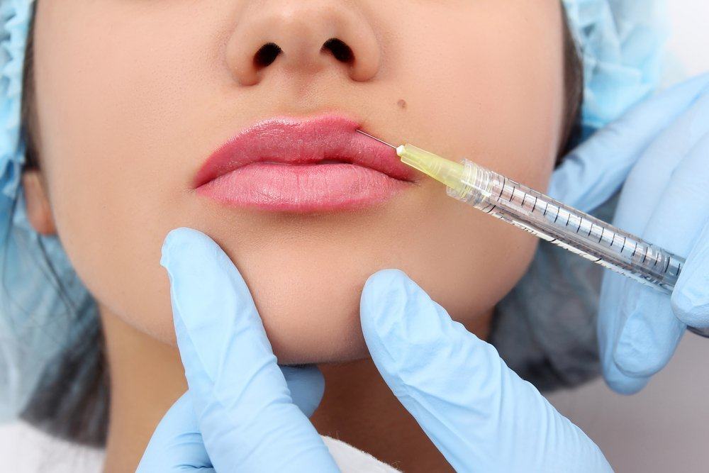 Ползи и рискове от удебеляване на устните с пълнител за устни