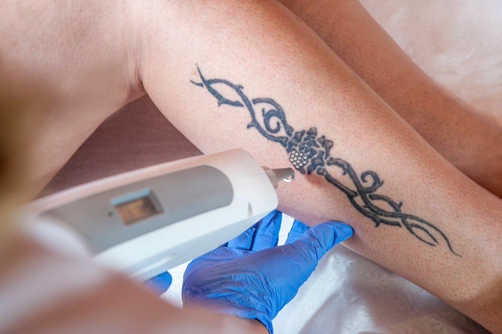 Странични ефекти от лазерното премахване на татуировки