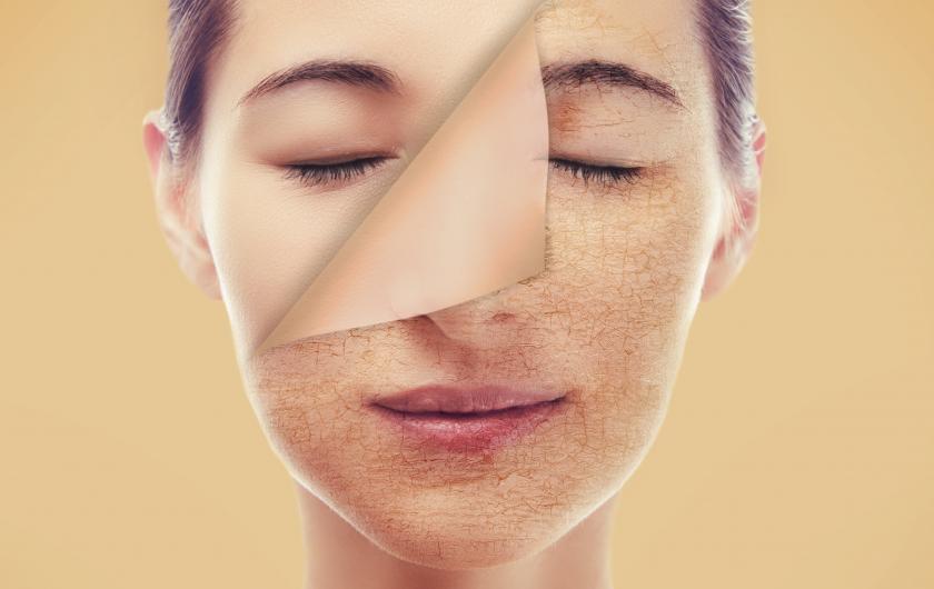 5 consigli per superare la pelle secca del viso