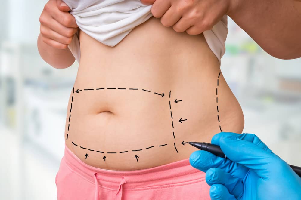 Risiko dan 7 Komplikasi Kerana Kesan Sampingan Liposuction