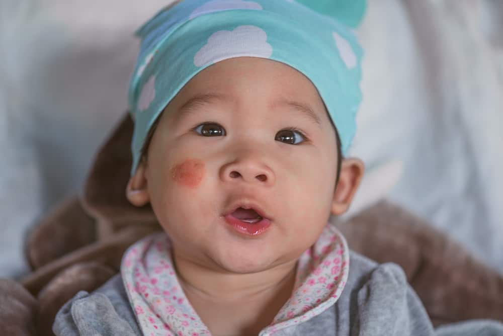 La causa della comparsa di un'eruzione cutanea eczema sulla guancia di un bambino non è il latte materno