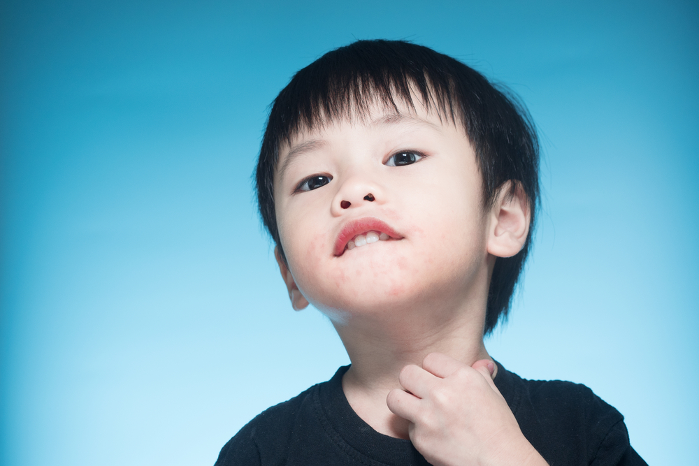子供の口の周りに赤い発疹が現れる、どう対処するか？