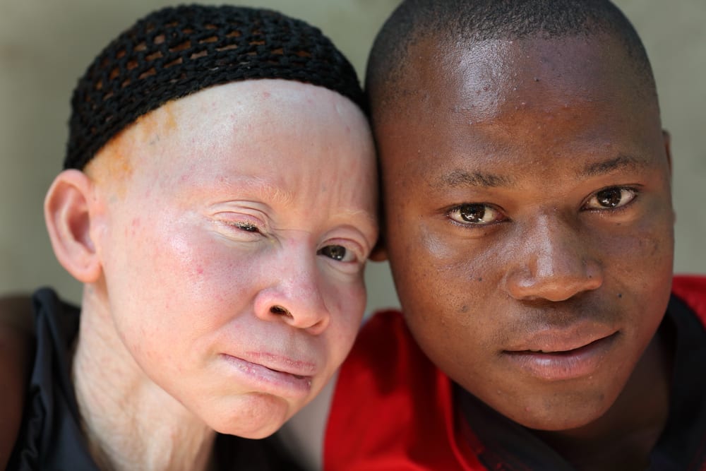 8 Fakta Menarik Tentang Albinisme (Albino) yang Perlu Anda Ketahui