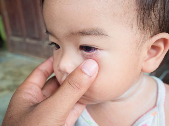 Bukan kerana kurang tidur, ini adalah 4 penyebab mata panda pada anak kecil anda
