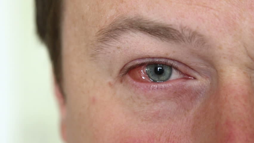 يمكن لفيروس الهربس أن يهاجم العيون ، ما هي العلامات والأعراض؟