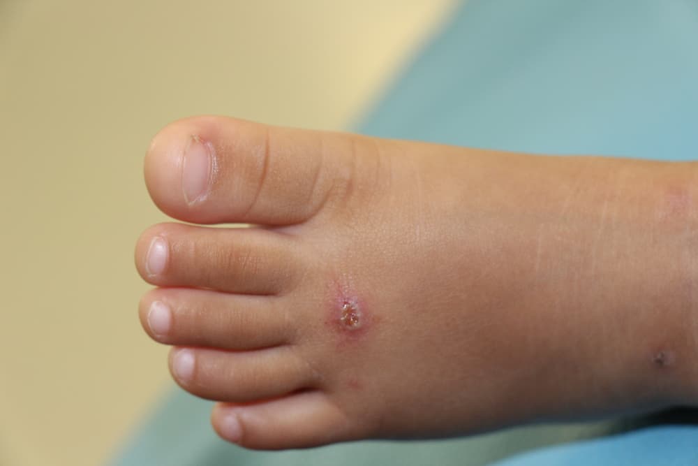 Le dita dei piedi o le lesioni del piede COVID potrebbero essere un sintomo del nuovo coronavirus?
