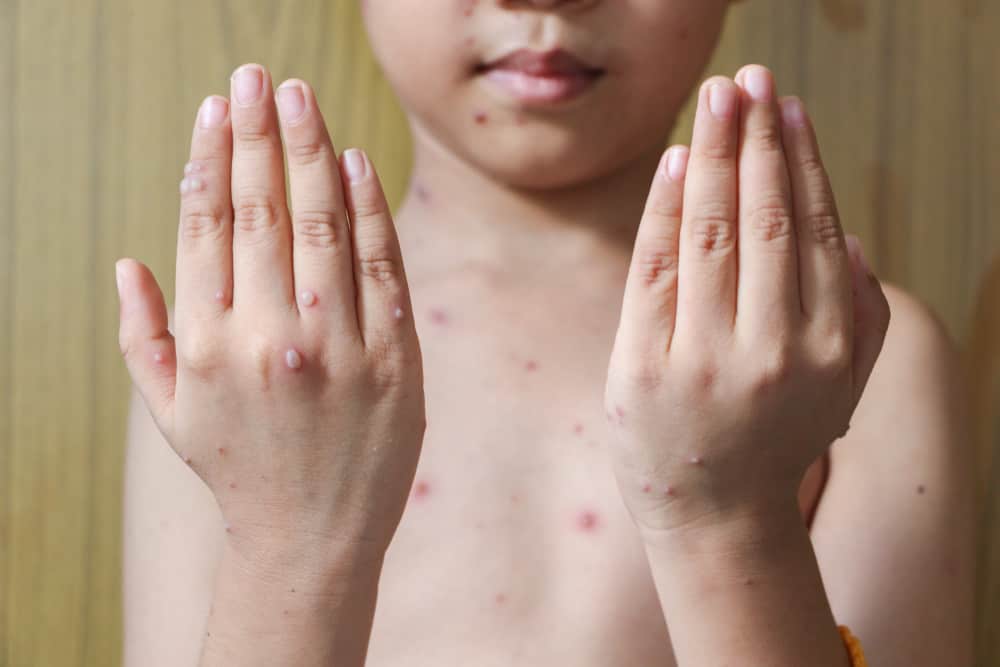 Attenzione alle cause della varicella e ai vari fattori di rischio
