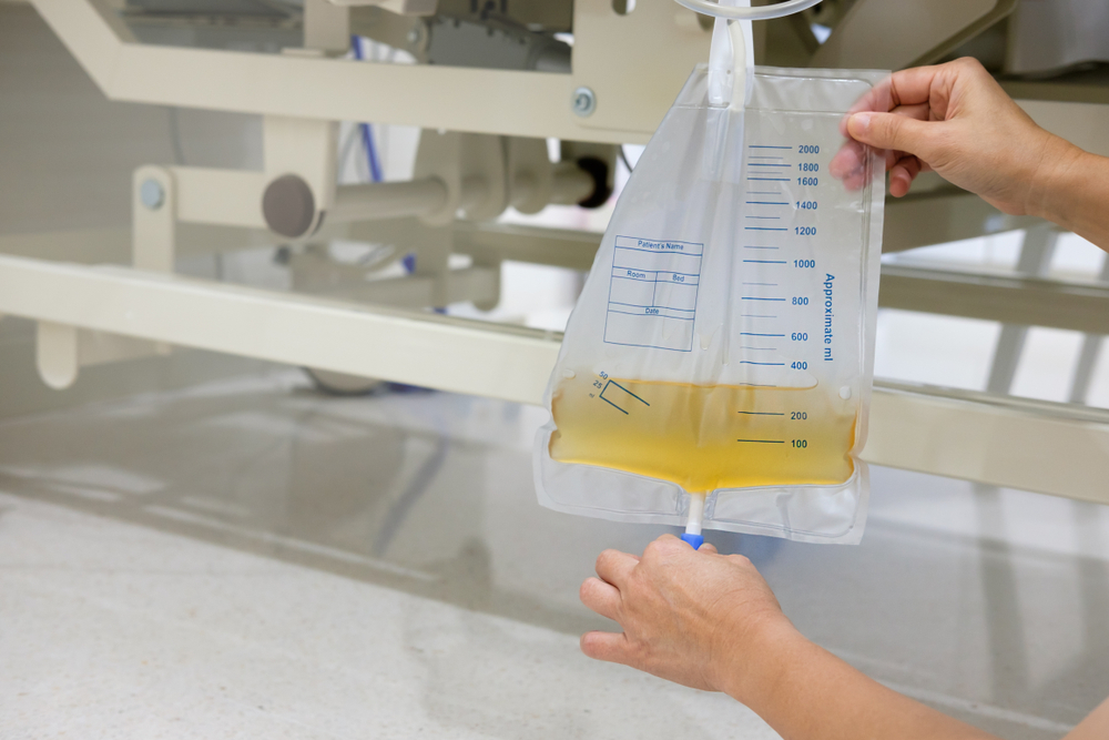 L'installazione di un catetere per l'urina può innescare l'infezione, capire come prevenirla